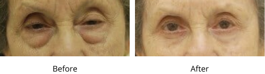 Eyelid Lift Before and After Las Vegas
