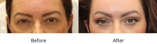 Brow lift Las Vegas