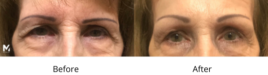Brow lift Las Vegas