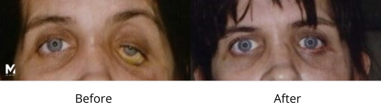 Eyelid Reconstruction Facelift Las Vegas