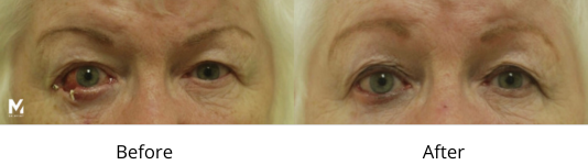 Eyelid Reconstruction Facelift Las Vegas