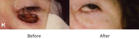 Eyelid Reconstruction Facelift Las Vegas