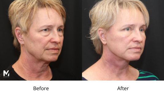 Deep Plane Facelift Las Vegas