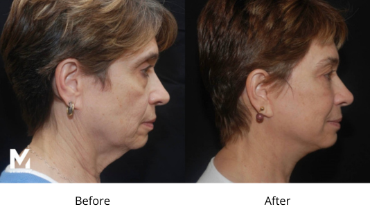 Deep Plane Facelift Las Vegas