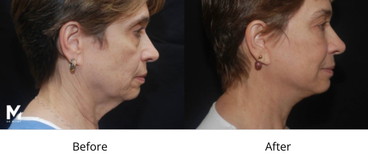 Neck Lift Before and After Las Vegas