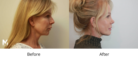 Neck Lift Before and After Las Vegas