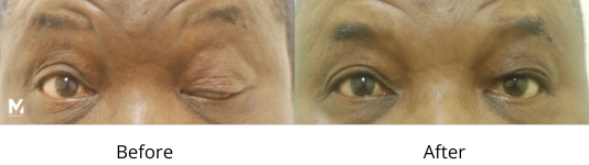 Ptosis Before and After Las Vegas