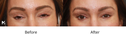 Ptosis Before and After Las Vegas