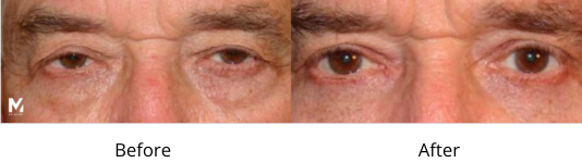 Ptosis Before and After Las Vegas