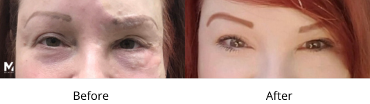 Revisional Eyelid Lift Before and After Las Vegas