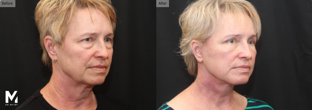 Facelift, Neck Lift, Las Vegas & Nevada