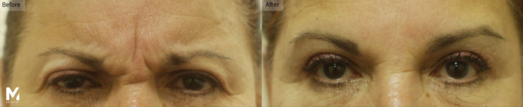 Botox®, Filler, Las Vegas & Nevada
