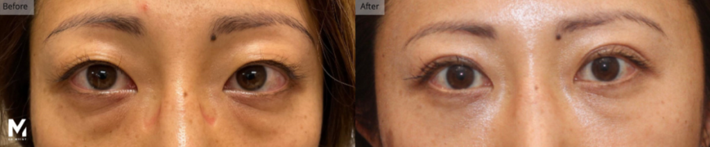 Eyelid Lift, Ptosis Surgery, Las Vegas & Nevada