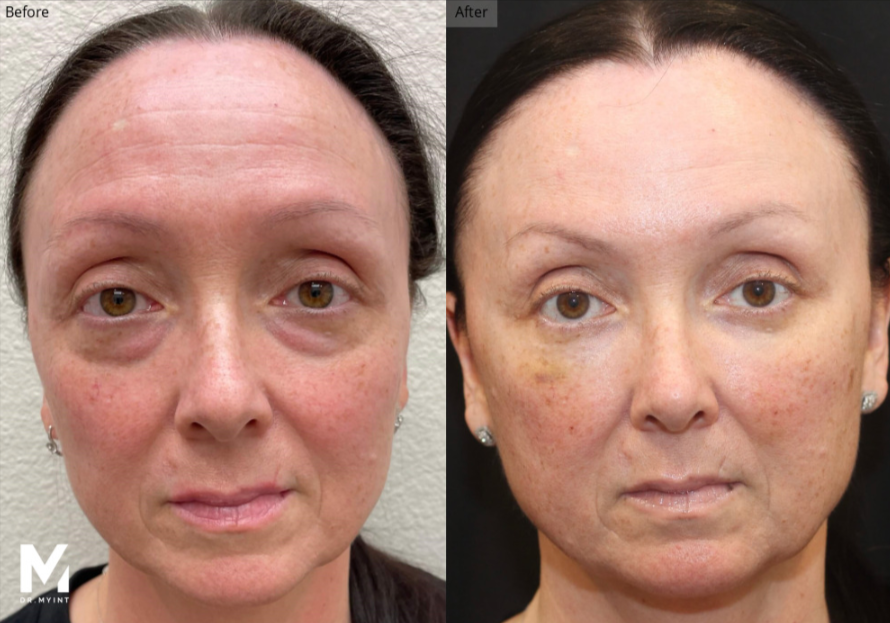Nanofat Skin Rejuvenation, RF Microneedling, Las Vegas & Nevada