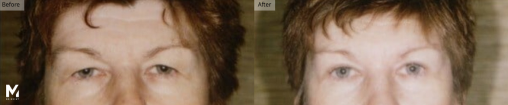 Eyelid Lift, Brow Lift, Las Vegas & Nevada