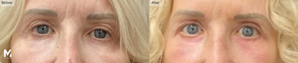 Eyelid Lift, Las Vegas & Nevada