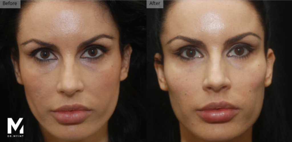 Botox, Dermal Fillers, Deep Plane Facelift, Las Vegas & Nevada