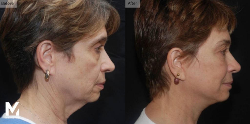 Deep Plane Facelift, Las Vegas & Nevada