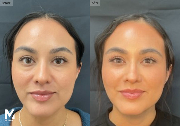Before and after close-up of a woman's face showing smoother skin and fuller lips after a procedure.