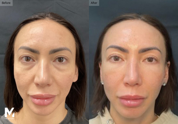 Before-and-after comparison of a woman's face after cosmetic treatment, showing fuller lips and improved skin texture on the right panel vs left panel.