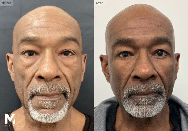 Before (left) and after (right) photos of a bald man with a gray beard, showing improved skin texture and even tone after treatment.